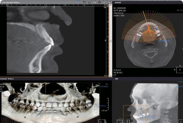3D CT 네비게이션 임플란트 이미지 영역